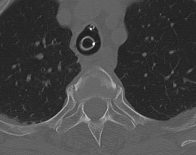 Acute on chronic subdural hematoma and thoracic vertebral injury in a multitrauma patient (Radiopaedia 31698-32619 Axial bone window 71).jpg