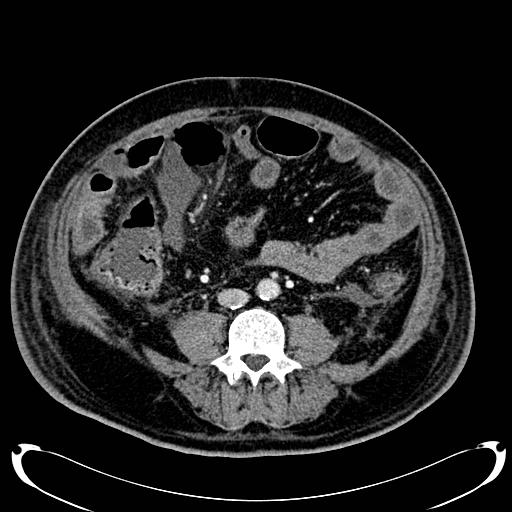 Acute pancreatic necrosis (Radiopaedia 13560-18500 Axial C+ portal venous phase 96).jpg