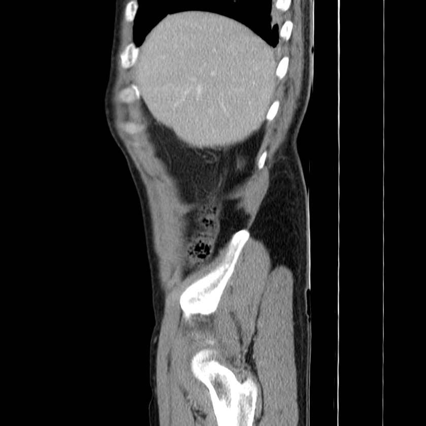 Acute pancreatitis (Radiopaedia 22572-22596 Sagittal C+ portal venous phase 9).jpg