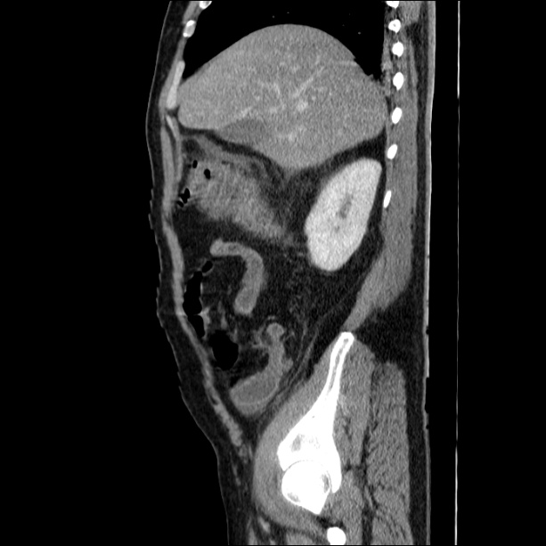Acute pancreatitis (Radiopaedia 26663-26813 Sagittal C+ portal venous phase 20).jpg