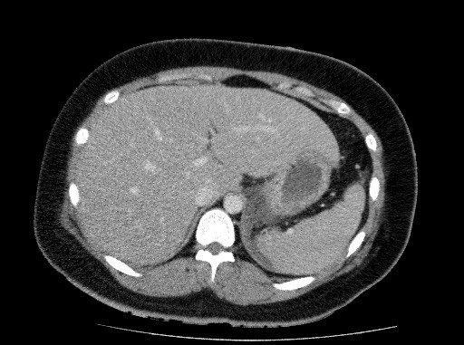 Acute pancreatitis (Radiopaedia 69236-79012 Axial C+ portal venous phase 22).jpg