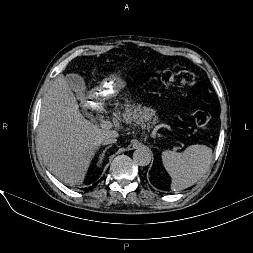 Acute pancreatitis (Radiopaedia 85146-100701 Axial non-contrast 35).jpg
