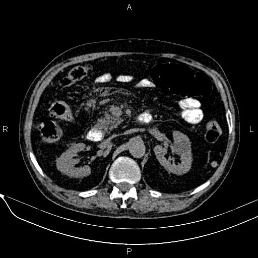 Acute pancreatitis (Radiopaedia 85146-100701 Axial non-contrast 50).jpg