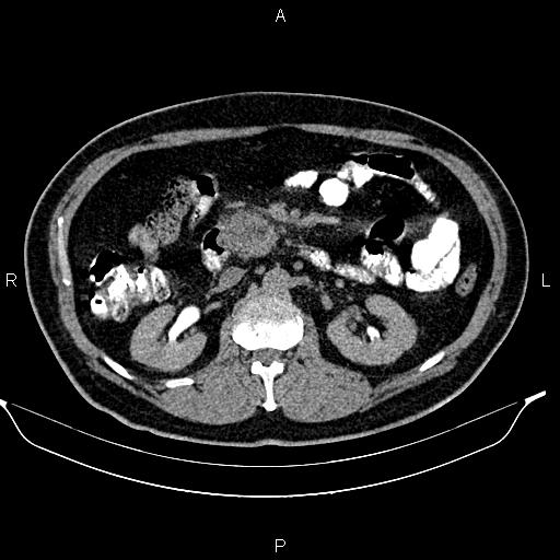 File:Acute pancreatitis (Radiopaedia 85390-101010 Axial C+ delayed 34).jpg