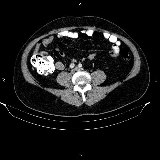 Acute pancreatitis (Radiopaedia 85390-101010 Axial C+ portal venous phase 70).jpg