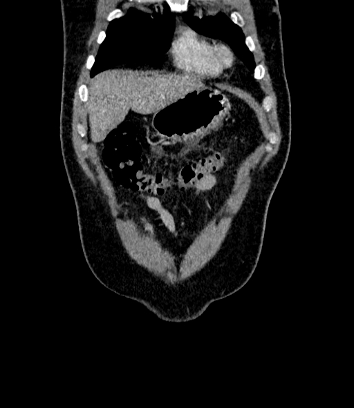 Acute pancreatitis (Radiopaedia 87428-103757 Coronal C+ portal venous phase 14).jpg