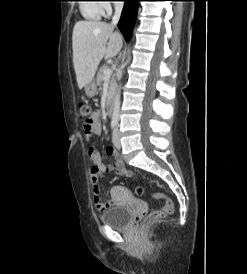 File:Acute pancreatitis - Balthazar E - post ERCP (Radiopaedia 27562-27772 Sagittal C+ portal venous phase 67).png