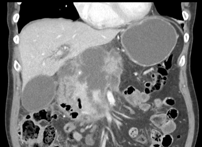 File:Acute pancreatitis and walled-off necrosis (Radiopaedia 29888-30404 Coronal C+ portal venous phase 21).jpg