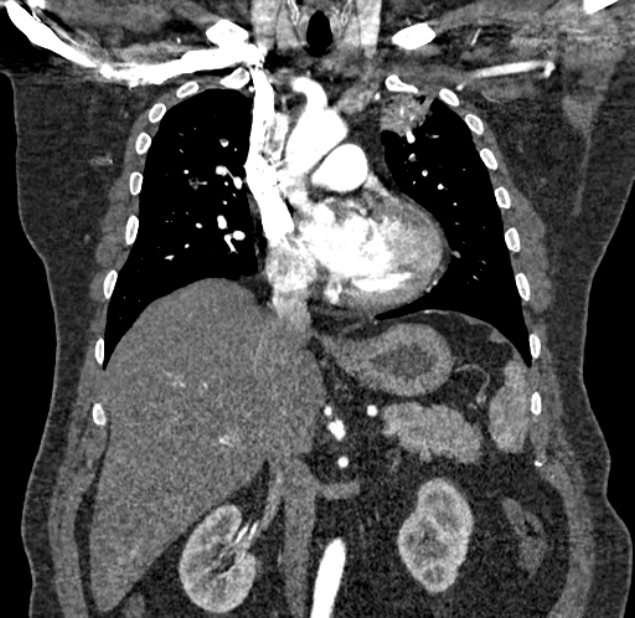 Acute pulmonary embolism with pulmonary infarcts (Radiopaedia 77688-89908 Coronal C+ CTPA 38).jpg