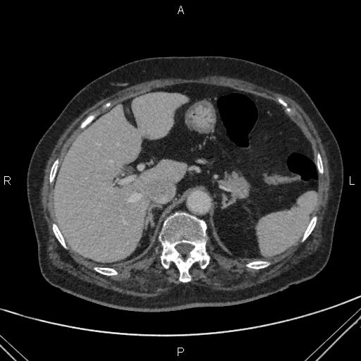 File:Acute renal artery occlusion (Radiopaedia 86586-102682 Axial C+ portal venous phase 15).jpg