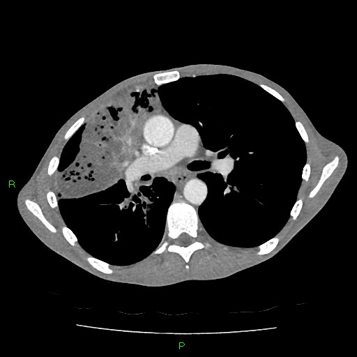 File:Acute right lung abscess (Radiopaedia 34806-36258 Axial C+ arterial phase 85).jpg