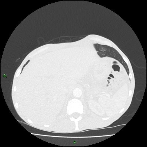File:Acute right lung abscess (Radiopaedia 34806-36258 Axial lung window 176).jpg