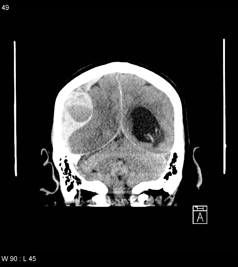 Acute subdural hematoma with myelofibrosis (Radiopaedia 52582-58494 Coronal non-contrast 40).jpg