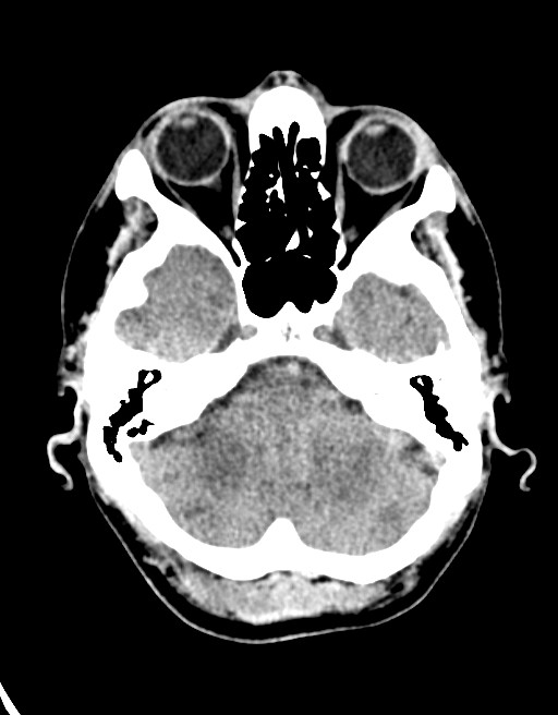 Acute superior cerebellar artery territory infarct (Radiopaedia 84104-99359 Axial non-contrast 52).jpg