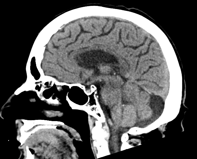 Acute traumatic subdural hematoma (Radiopaedia 82921-97257 Sagittal non-contrast 40).jpg