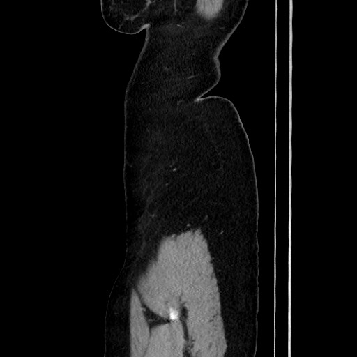 File:Acute uncomplicated appendicitis (Radiopaedia 73704-84499 Sagittal C+ portal venous phase 40).jpg