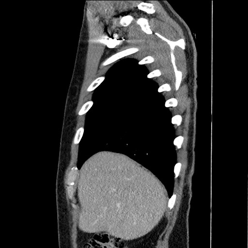 Adenocarcinoma of the lung (Radiopaedia 59871-67325 Sagittal C+ arterial phase 12).jpg