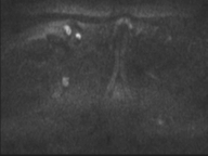 Adenocarcioma of rectum- T1 lesion (Radiopaedia 36921-38546 Axial DWI 62).png