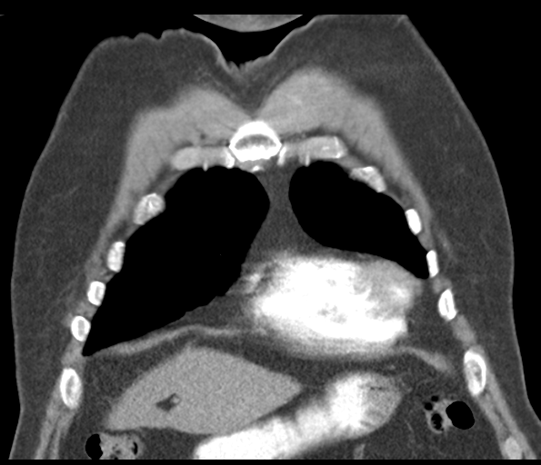 Adenocarcioma of rectum- T1 lesion (Radiopaedia 36921-38547 Coronal C+ arterial phase 17).png