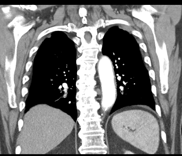 Adenocarcioma of rectum- T1 lesion (Radiopaedia 36921-38547 Coronal C+ arterial phase 45).png