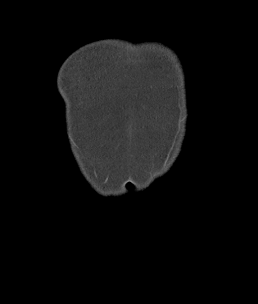 Adenocarcioma of rectum- T1 lesion (Radiopaedia 36921-38547 Coronal C+ portal venous phase 2).png