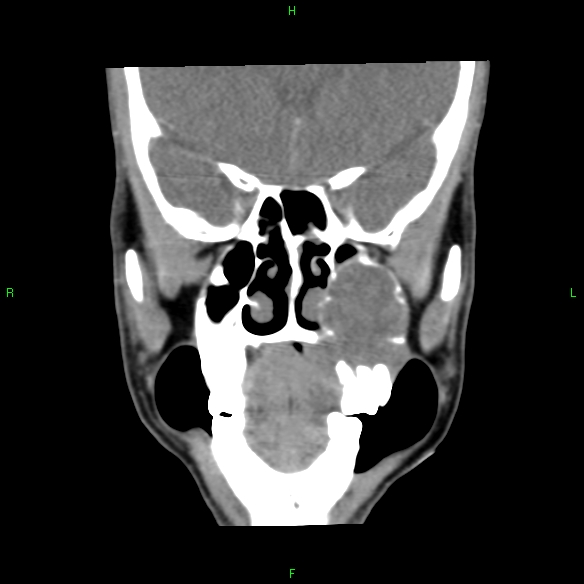File:Adenoid cystic carcinoma of hard palate (Radiopaedia 26137-26273 Coronal liver window 11).jpg