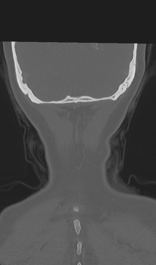 Adenoid cystic tumor of palate (Radiopaedia 46980-51518 Coronal bone window 55).png