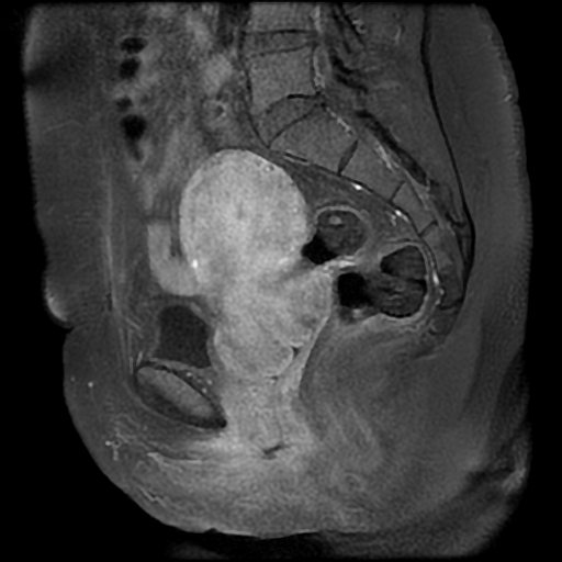 File:Adenomyosis-scar endometriosis (Radiopaedia 65863-75022 Sagittal T1 C+ fat sat 12).jpg