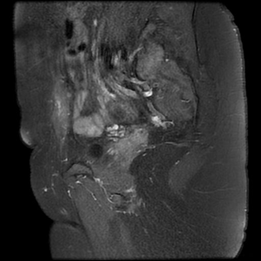 File:Adenomyosis-scar endometriosis (Radiopaedia 65863-75022 Sagittal T1 C+ fat sat 7).jpg