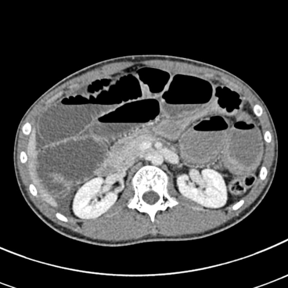 Adhesional small bowel obstruction (Radiopaedia 52107-57980 Axial C+ portal venous phase 40).jpg
