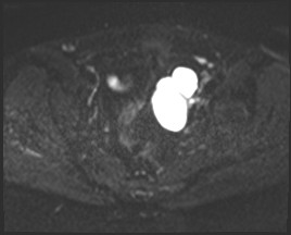 Adnexal multilocular cyst (O-RADS US 3- O-RADS MRI 3) (Radiopaedia 87426-103754 Axial DWI 13).jpg