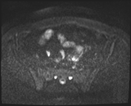 File:Adnexal multilocular cyst (O-RADS US 3. O-RADS MRI 3) (Radiopaedia 87426-103754 Axial 116).jpeg