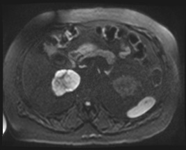 Adrenal cortical carcinoma (Radiopaedia 64017-72770 Axial DWI 103).jpg