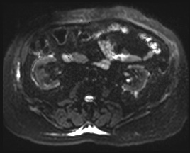 File:Adrenal cortical carcinoma (Radiopaedia 64017-72770 Axial DWI 29).jpg