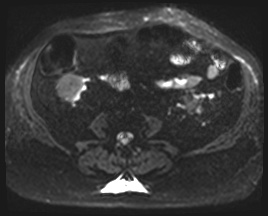 Adrenal cortical carcinoma (Radiopaedia 64017-72770 Axial DWI 38).jpg