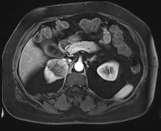 File:Adrenal cortical carcinoma (Radiopaedia 64017-72770 I 35).jpg