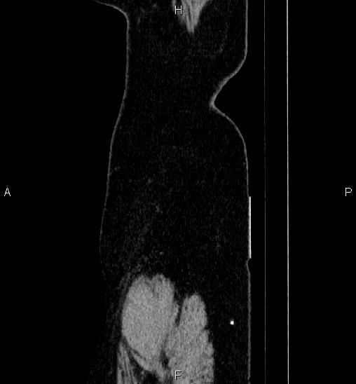 File:Adrenal cortical carcinoma (Radiopaedia 84882-100379 Sagittal C+ portal venous phase 90).jpg