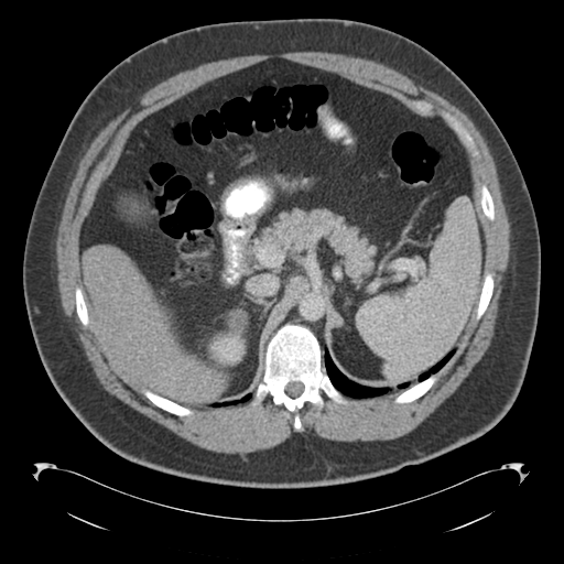 File:Adrenal cyst (Radiopaedia 45625-49776 Axial C+ portal venous phase 30).png