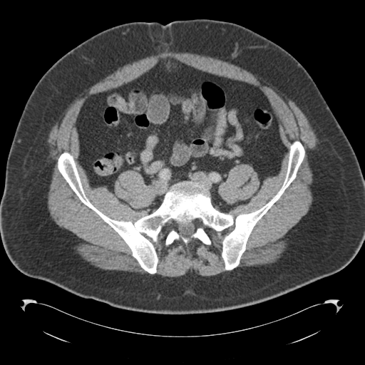 File:Adrenal cyst (Radiopaedia 45625-49776 Axial C+ portal venous phase 70).png