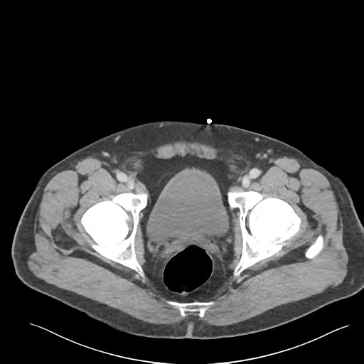 Adrenal cyst (Radiopaedia 45625-49777 Axial C+ portal venous phase 96).png