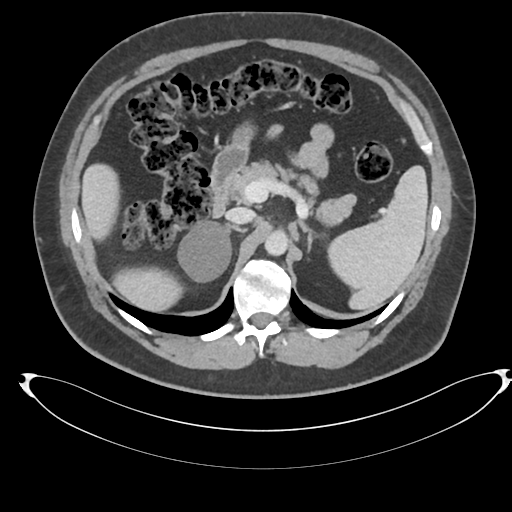 File:Adrenal cyst (Radiopaedia 45625-49778 AXIAL THICK 60 sec 21).png
