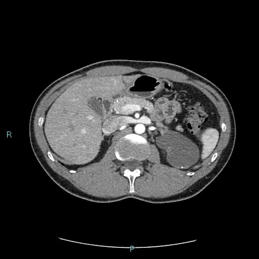 Adrenal cystic lymphangioma (Radiopaedia 83161-97534 Axial C+ arterial phase 32).jpg