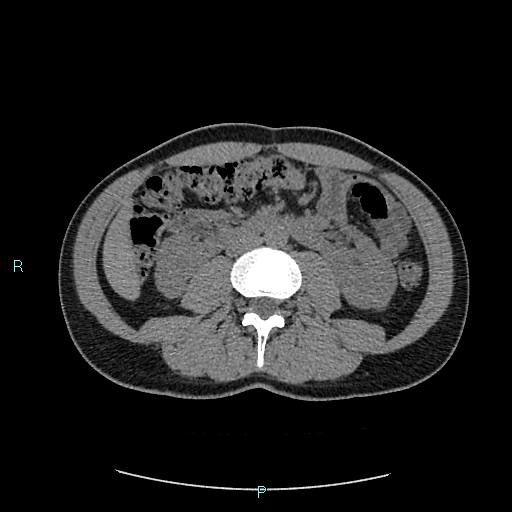 Adrenal cystic lymphangioma (Radiopaedia 83161-97534 Axial non-contrast 49).jpg