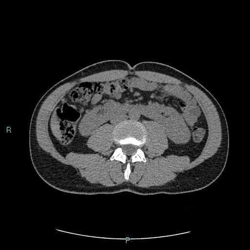 File:Adrenal cystic lymphangioma (Radiopaedia 83161-97534 Axial non-contrast 52).jpg