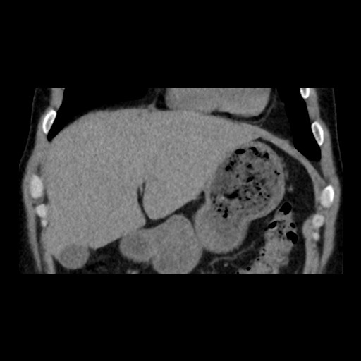 Adrenal gland trauma (Radiopaedia 81351-95079 Coronal non-contrast 25).jpg