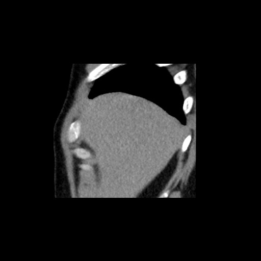 Adrenal gland trauma (Radiopaedia 81351-95079 Sagittal non-contrast 10).jpg