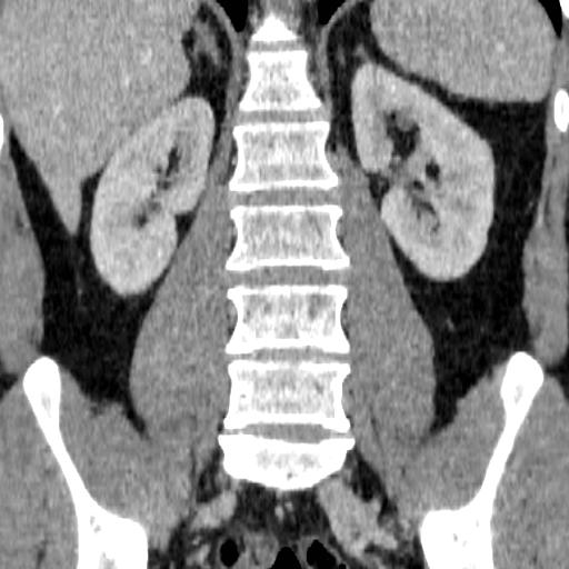 File:Adrenal glands (normal CT anatomy) (Radiopaedia 16570-105725 Coronal 14).jpg