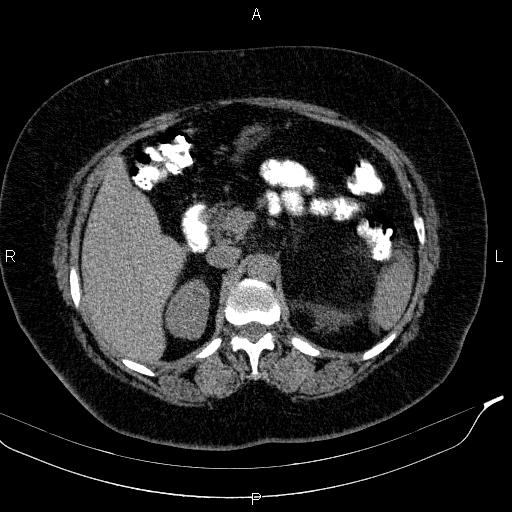 Adrenal myelolipoma (Radiopaedia 84319-99617 Axial With oral contrast 74).jpg
