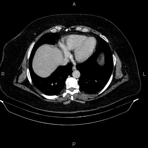 Adrenal myelolipoma (Radiopaedia 84319-99617 Axial renal cortical phase 14).jpg