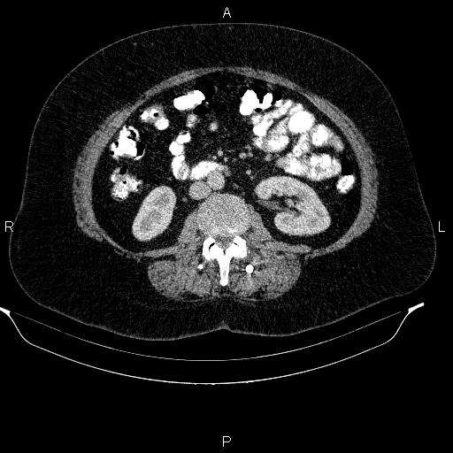 Adrenal myelolipoma (Radiopaedia 84319-99617 Axial renal cortical phase 58).jpg